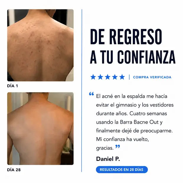 Reduce visiblemente el acné de espalda y cuerpo en semanas