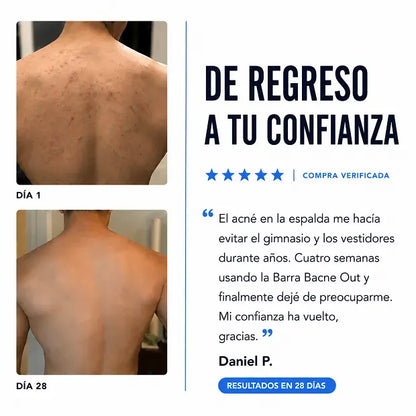 Reduce visiblemente el acné de espalda y cuerpo en semanas