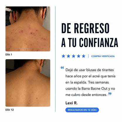 Reduce visiblemente el acné de espalda y cuerpo en semanas